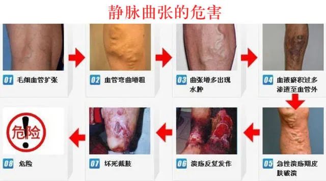 静脉曲张危害.jpg 静脉曲张危害.jpg